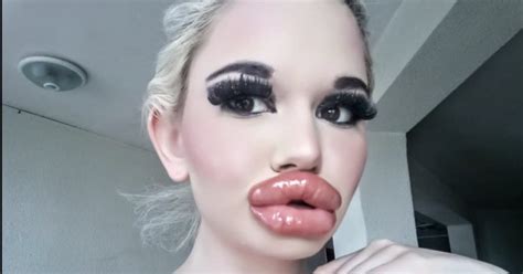 Extrem Grosse Schamlippen Huge Lips: Swiss Close